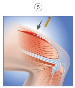 Illustration of a knee joint with the PRP being injected into the torn thigh muscle.