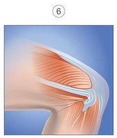 Illustration of the knee joint with the muscle showing signs of healing.
