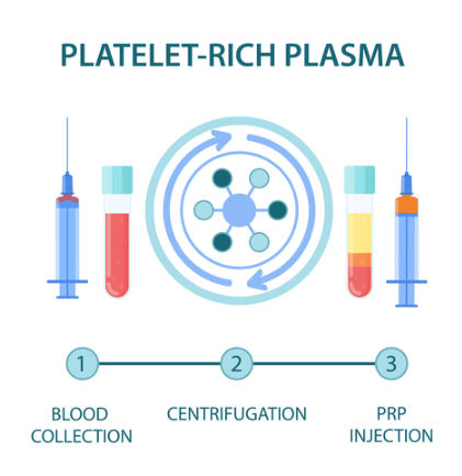 The illustration shows three primary steps of PRP therapy: 1) Blood Collection: a needle next to a tube of blood; 2) Centrifugation: a spinning centrifuge; 3) PRP Injection: a needle and a tube of platelet-rich plasma that has been separated from the bloo