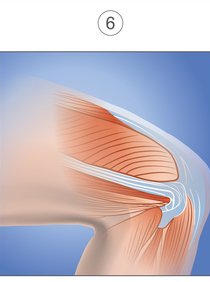 Illustration of the knee joint with the muscle showing signs of healing.