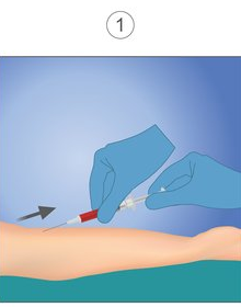 Illustration of blood being drawn from patient's arm.