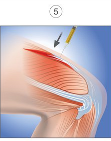 Illustration of a knee joint with the PRP being injected into the torn thigh muscle.