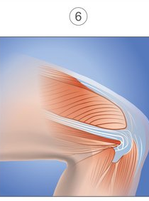 Illustration of the knee joint with the muscle showing signs of healing.